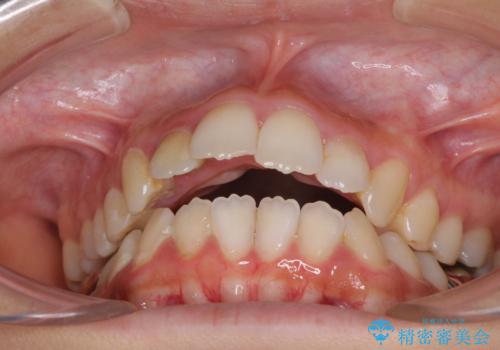 開咬と前突を改善 ワイヤー装置での抜歯矯正の治療前