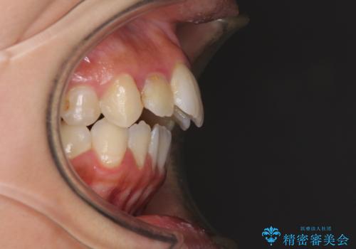 開咬と前突を改善 ワイヤー装置での抜歯矯正の治療前