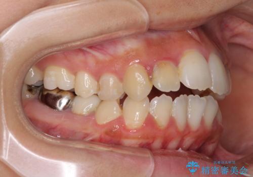 開咬と前突を改善 ワイヤー装置での抜歯矯正の治療前