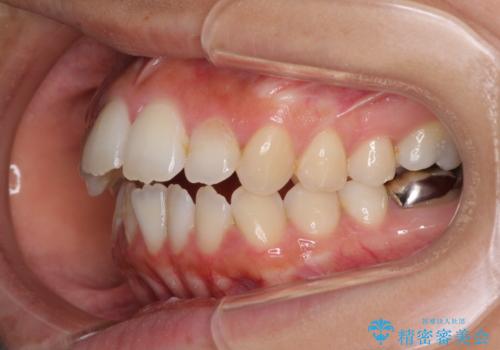 開咬と前突を改善 ワイヤー装置での抜歯矯正の治療前