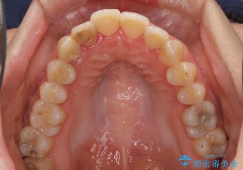 開咬と前突を改善 ワイヤー装置での抜歯矯正の治療前