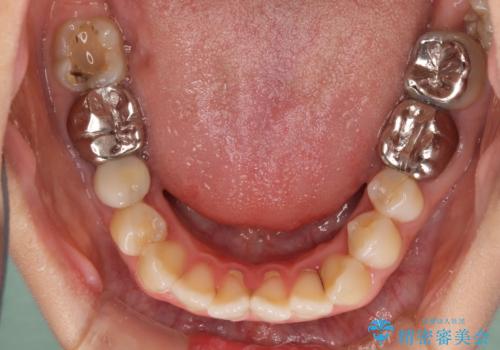 開咬と前突を改善 ワイヤー装置での抜歯矯正の治療前