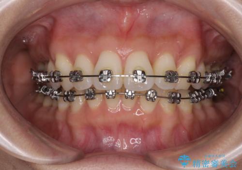 上顎前突をしっかりと治す　補助装置を使用したワイヤー矯正の治療中