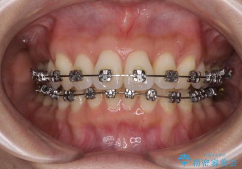 上顎前突をしっかりと治す 補助装置を使用したワイヤー矯正の治療中