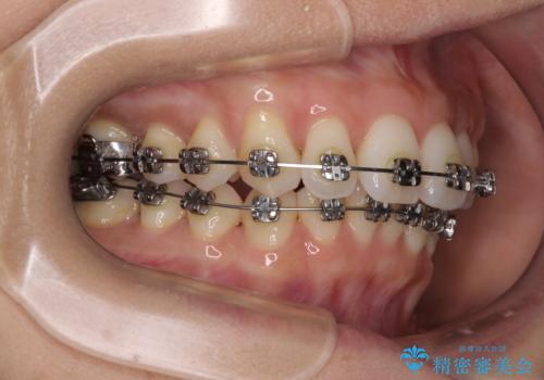 上顎前突をしっかりと治す 補助装置を使用したワイヤー矯正の治療中