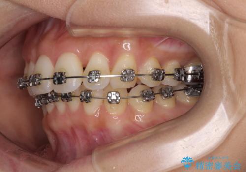 上顎前突をしっかりと治す 補助装置を使用したワイヤー矯正の治療中