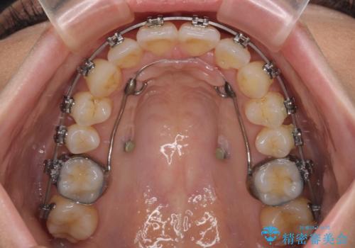 上顎前突をしっかりと治す　補助装置を使用したワイヤー矯正の治療中