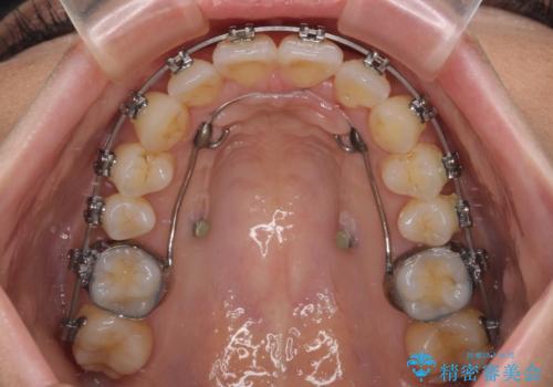 上顎前突をしっかりと治す 補助装置を使用したワイヤー矯正の治療中