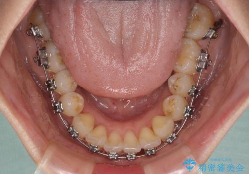 上顎前突をしっかりと治す 補助装置を使用したワイヤー矯正の治療中