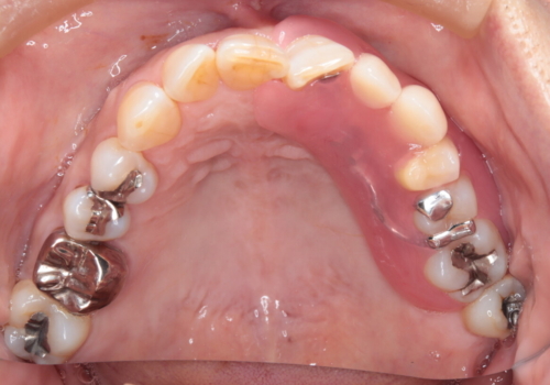 目立たない入れ歯　ノンクラスプデンチャーの治療後