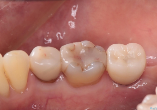 奥歯に歯を入れたい。インプラント治療の治療後