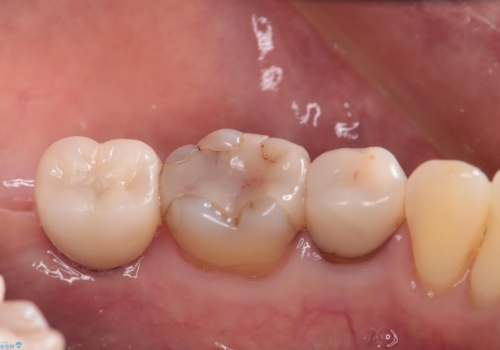 奥歯に歯を入れたい。インプラント治療