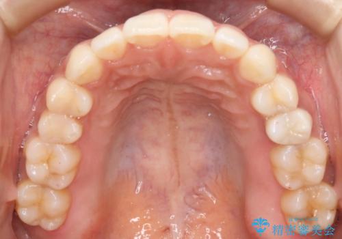 インビザラインの弱点をワイヤーでフォローの治療後
