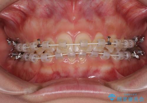 ディープバイトを短期間で改善 ワイヤー矯正治療の治療中