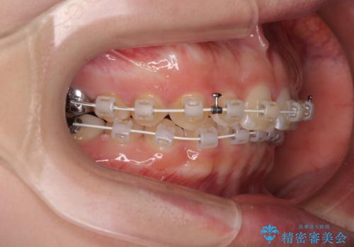 ディープバイトを短期間で改善 ワイヤー矯正治療の治療中