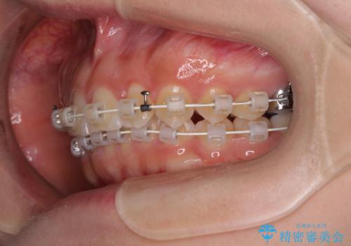ディープバイトを短期間で改善 ワイヤー矯正治療の治療中