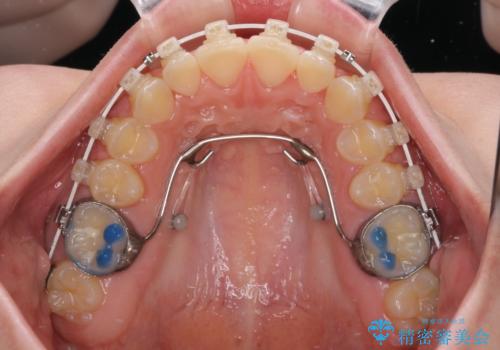 ディープバイトを短期間で改善　ワイヤー矯正治療の治療中