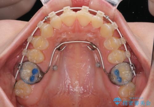 ディープバイトを短期間で改善 ワイヤー矯正治療の治療中