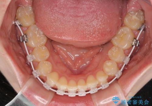 ディープバイトを短期間で改善 ワイヤー矯正治療の治療中