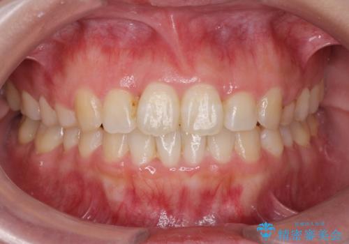 前歯のねじれをマウスピース矯正インビザラインで治療の症例 治療後