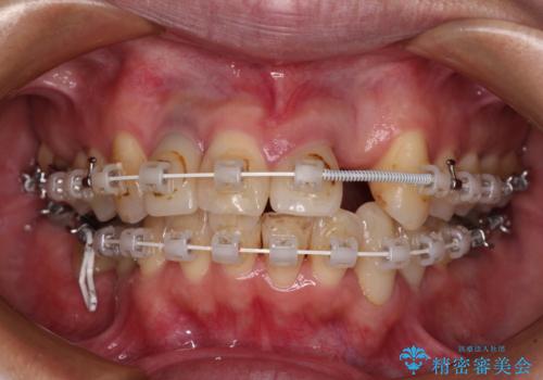 非対称の前歯を整えたい　矯正治療と審美治療の総合歯科診療の治療中