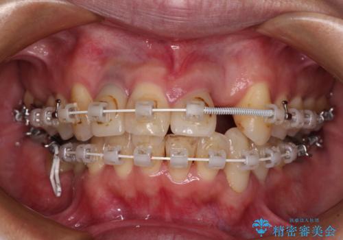 非対称の前歯を整えたい 矯正治療と審美治療の総合歯科診療の治療中