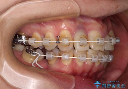 非対称の前歯を整えたい 矯正治療と審美治療の総合歯科診療の治療中