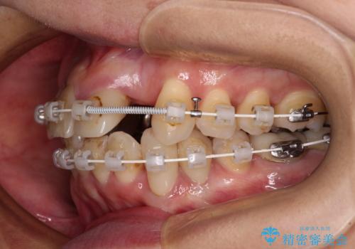 非対称の前歯を整えたい 矯正治療と審美治療の総合歯科診療の治療中