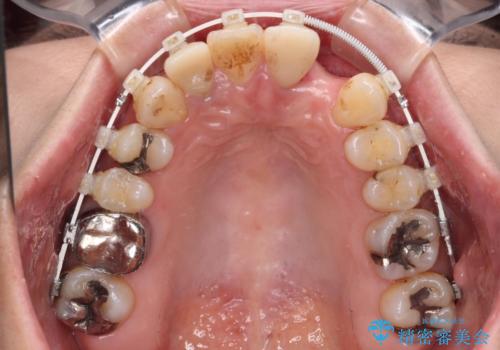 非対称の前歯を整えたい 矯正治療と審美治療の総合歯科診療の治療中