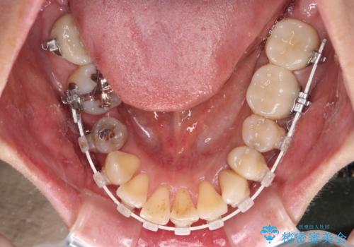非対称の前歯を整えたい 矯正治療と審美治療の総合歯科診療の治療中