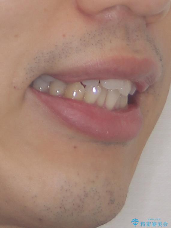 口元が出ているのが気になる。審美装置による抜歯矯正の治療前(顔貌)