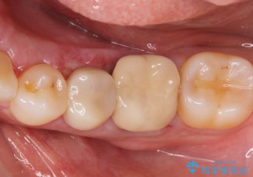 骨隆起除去の症例 治療後