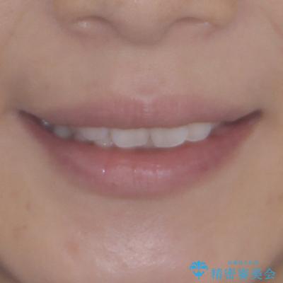 上顎前突をしっかりと治す 補助装置を使用したワイヤー矯正の治療前(顔貌)