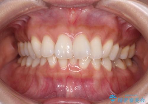 上顎前突をしっかりと治す 補助装置を使用したワイヤー矯正の症例 治療前