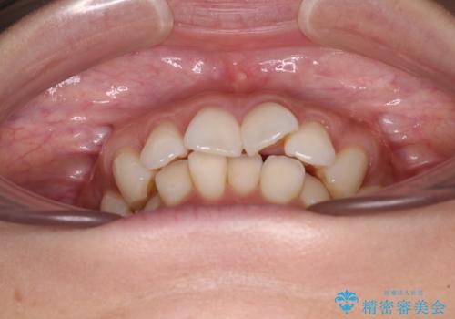 上顎前突をしっかりと治す 補助装置を使用したワイヤー矯正の治療前