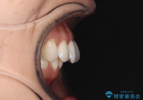 上顎前突をしっかりと治す 補助装置を使用したワイヤー矯正の治療前