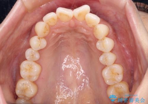 上顎前突をしっかりと治す　補助装置を使用したワイヤー矯正の治療前