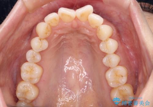 上顎前突をしっかりと治す 補助装置を使用したワイヤー矯正の治療前