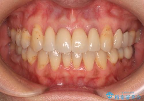 前歯をきれいにやり替えたいの症例 治療後