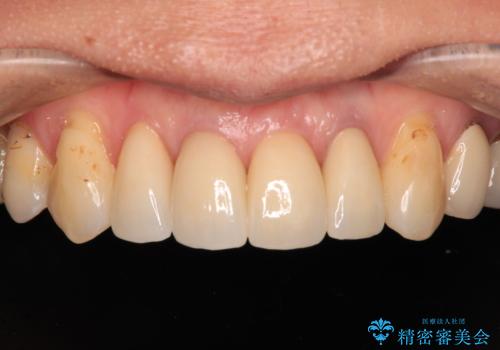 前歯をきれいにやり替えたいの治療後