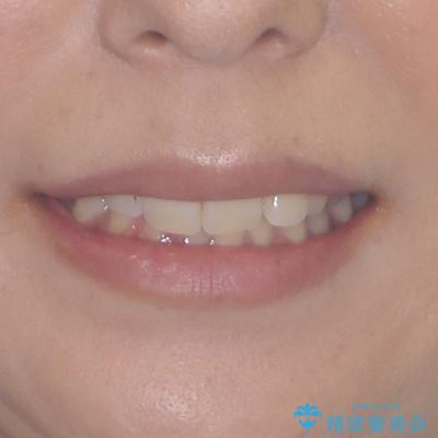 目立つ八重歯を改善 ワイヤー装置での抜歯矯正の治療前(顔貌)