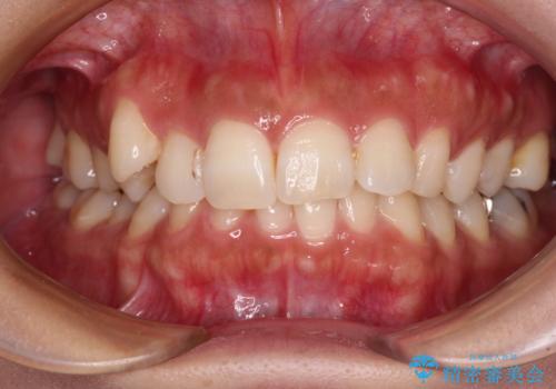 目立つ八重歯を改善 ワイヤー装置での抜歯矯正の症例 治療前