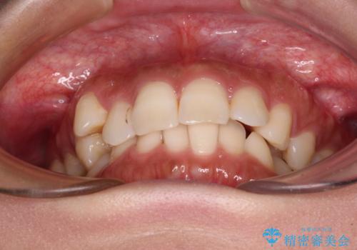 目立つ八重歯を改善 ワイヤー装置での抜歯矯正の治療前