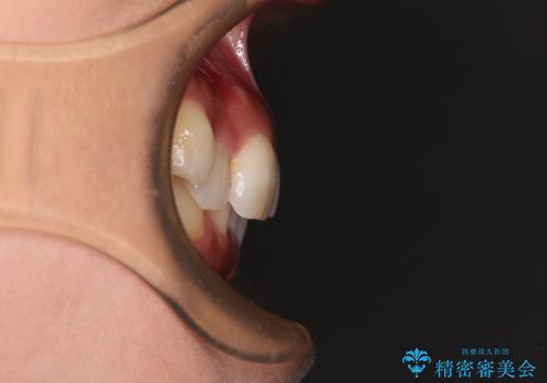 目立つ八重歯を改善 ワイヤー装置での抜歯矯正の治療前