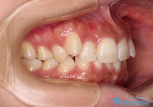 目立つ八重歯を改善 ワイヤー装置での抜歯矯正の治療前