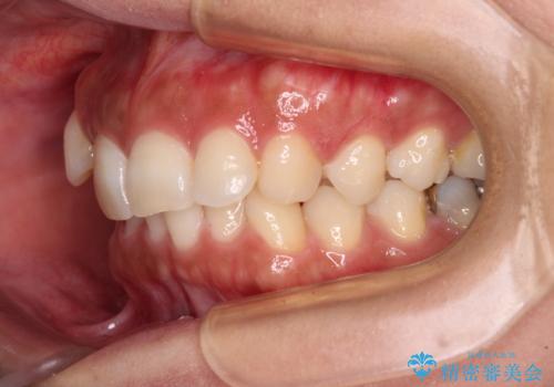 目立つ八重歯を改善 ワイヤー装置での抜歯矯正の治療前