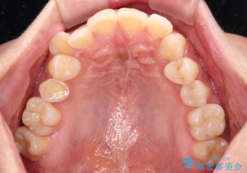 目立つ八重歯を改善 ワイヤー装置での抜歯矯正の治療前