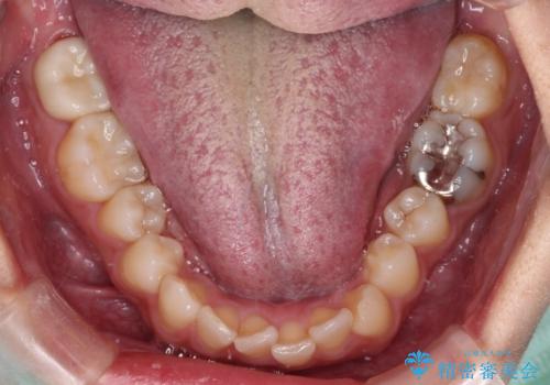 目立つ八重歯を改善 ワイヤー装置での抜歯矯正の治療前