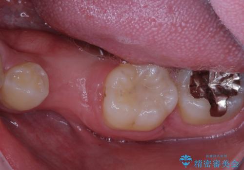 永久歯の先天欠如 インプラントによる補綴の症例 治療前