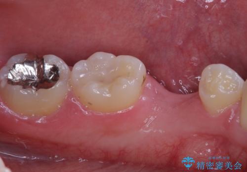 永久歯の先天欠如　インプラントによる補綴の治療前